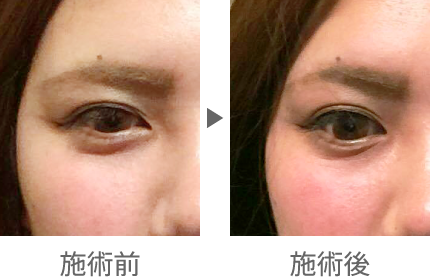 美容鍼を受ける前と受けた後の違いの写真